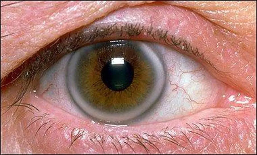 Arcus senilis clinical appearance showing white or grey lipid ring around the edge of the cornea at Hirocon Singapore