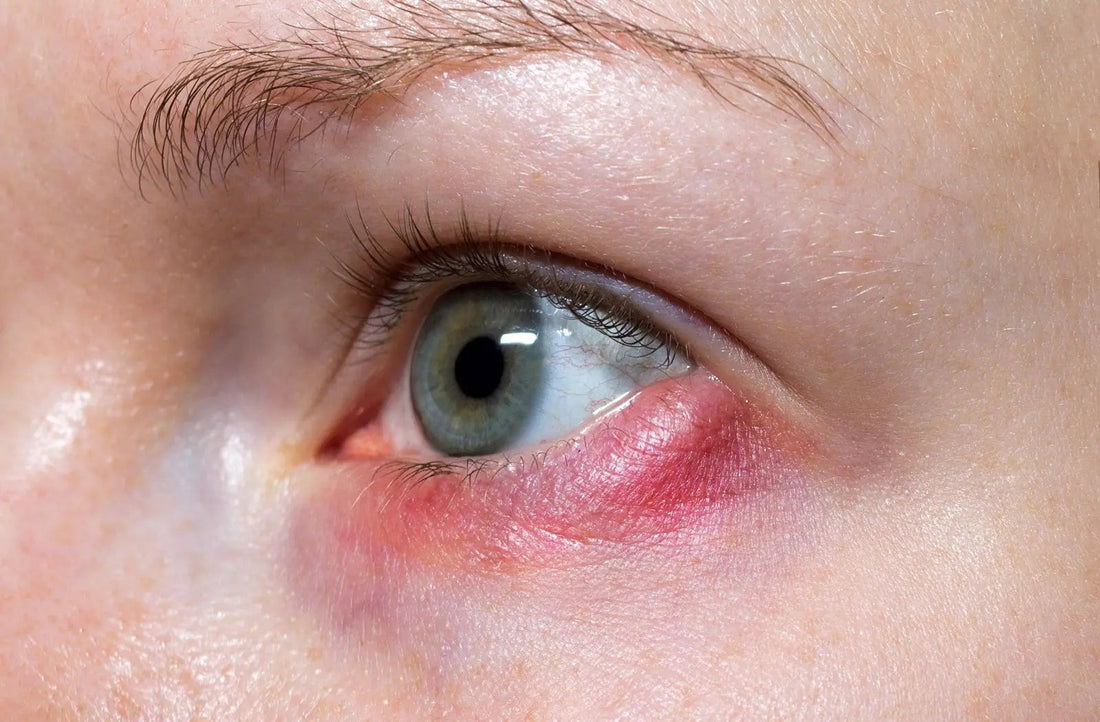 Blepharitis eyelid inflammation with anterior staphylococcal crusting and posterior MGD signs at Hirocon Singapore