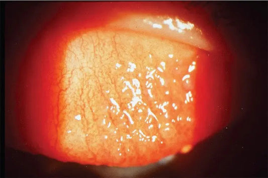 Contact Lenses Associated Papillae Conjunctivits