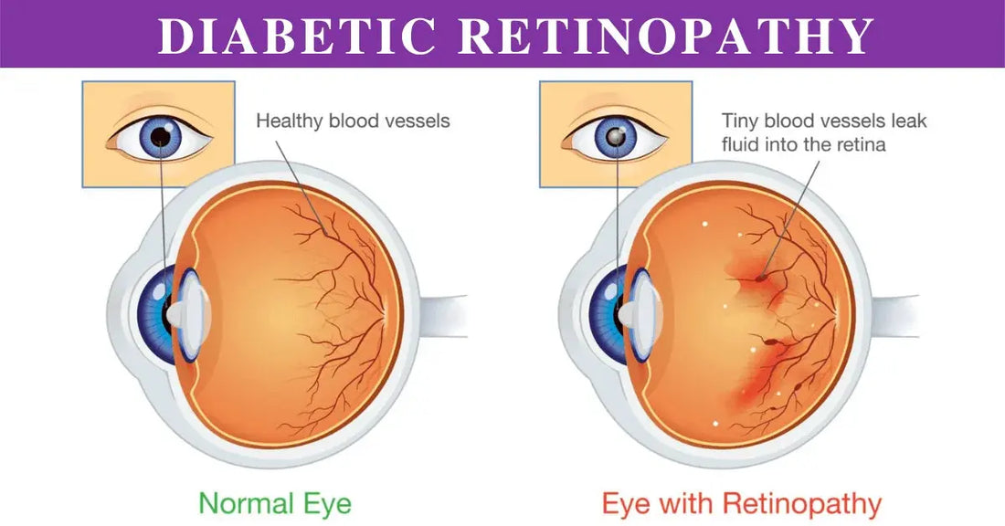 Understanding Diabetic Retinopathy: key symptoms, risk factors, and professional retinal screening at Hirocon Singapore.