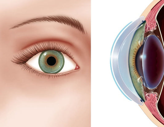 Corneal neovascularization blood vessel growth caused by chronic hypoxia from contact lens wear at Hirocon Singapore