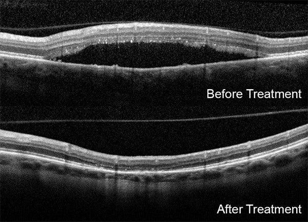 Understanding Central Serous Retinopathy (CSR): symptoms, risk factors, and professional clinical eye care at Hirocon SG.