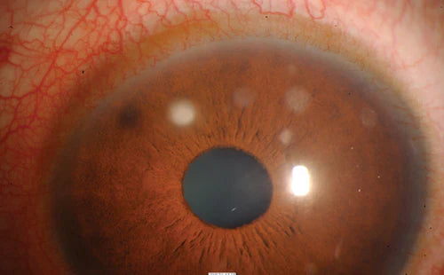 Contact lens associated infiltrative keratitis clinical signs with corneal opacities and eye redness diagnosis at Hirocon