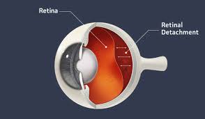 Clinical illustration of retinal detachment symptoms and the urgent need for professional medical attention at Hirocon SG