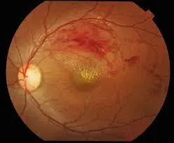 Understanding Branch Retinal Vein Occlusion (BRVO): causes, symptoms, and professional clinical eye care at Hirocon Singapore.