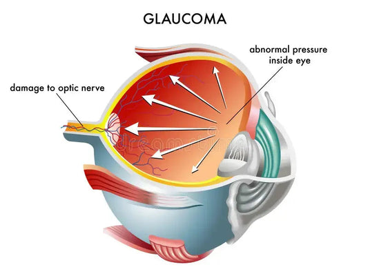 Understanding Glaucoma: POAG, ACG, and NTG types, symptoms, and professional clinical management at Hirocon Singapore.