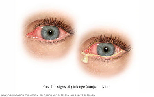 Understanding Pink Eye (conjunctivitis): viral, bacterial, and allergic types, plus clinical care options at Hirocon SG.