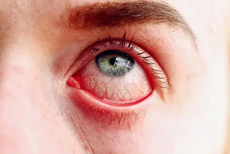Types of red eyes caused by conjunctivitis, dry eye, and ocular conditions requiring professional exams at Hirocon Singapore