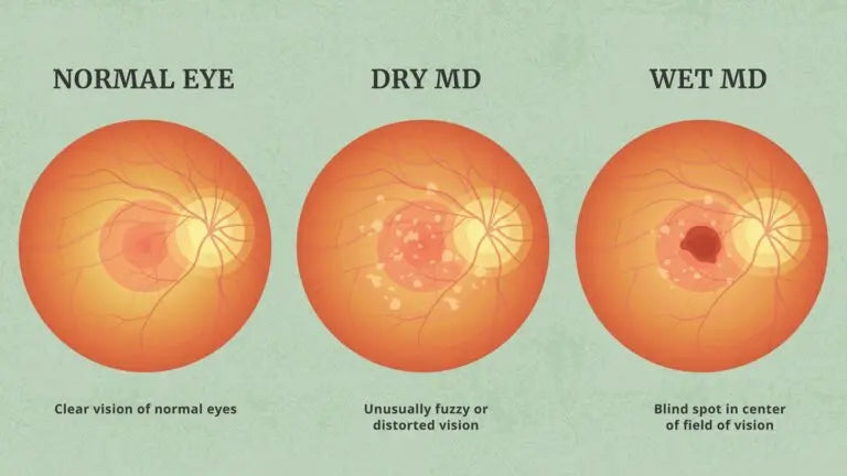 Understanding Age-Related Macular Degeneration (AMD): dry vs wet types, warning signs, and professional care at Hirocon SG.