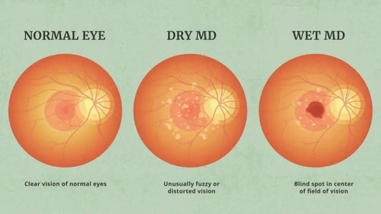 Understanding Age-Related Macular Degeneration (AMD): dry vs wet types, warning signs, and professional care at Hirocon SG.